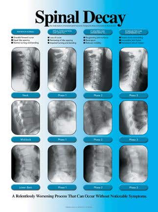 SpinalDecayChart,Laminated