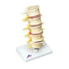 3b Scientific Anatomical Model - Vertebrae Degeneration, Stages Of Prolapsed Disc - Anatomical Model - Vertebrae Degeneration, Stages Of Prolapsed Disc
