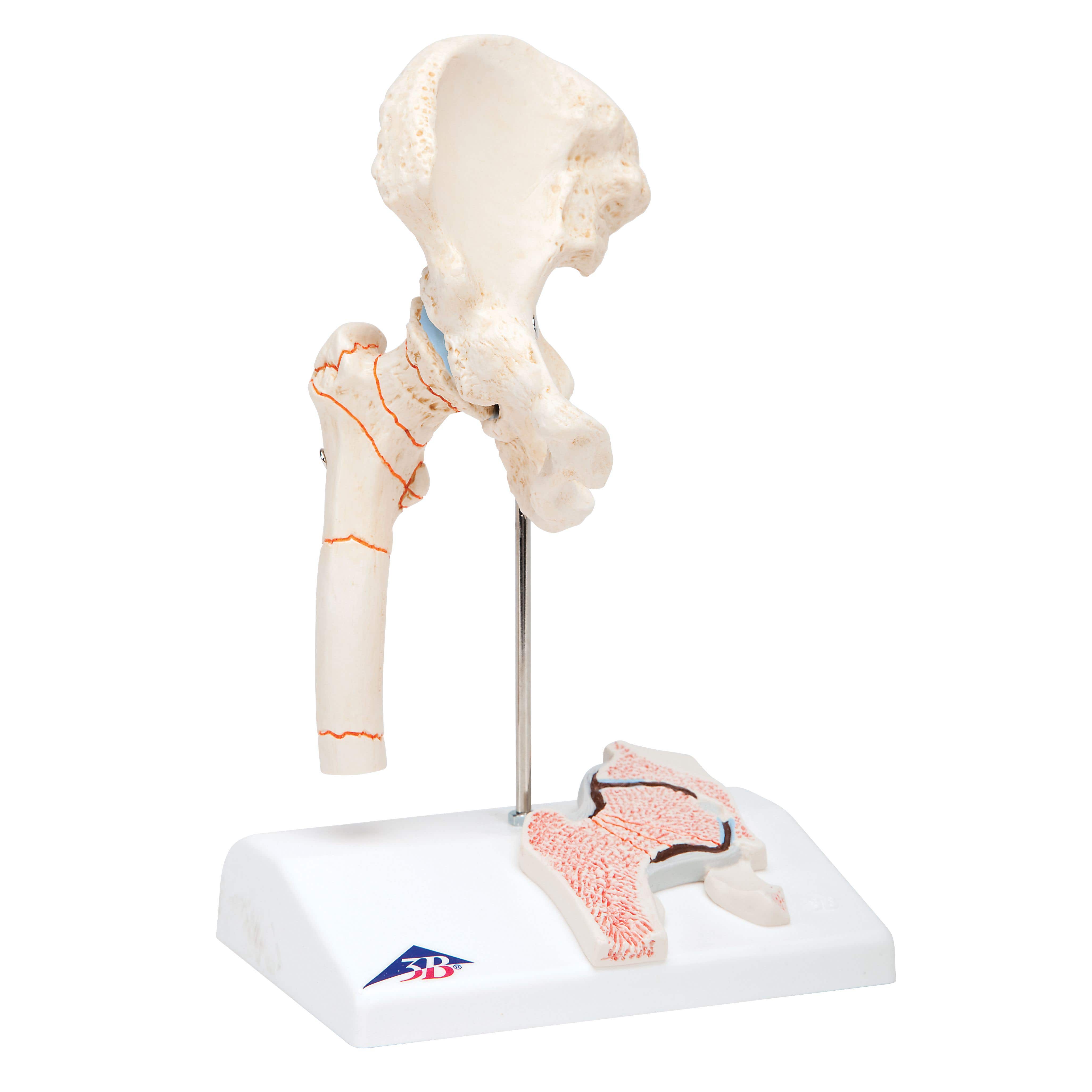 FemoralFractureAndHip