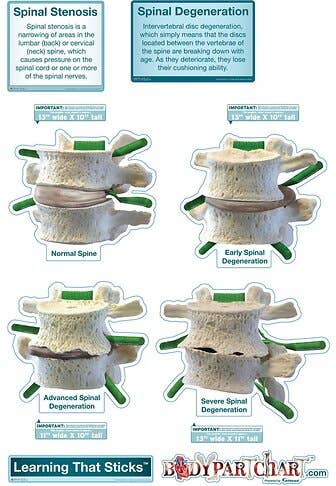BodyPartChart Spinal Degeneration